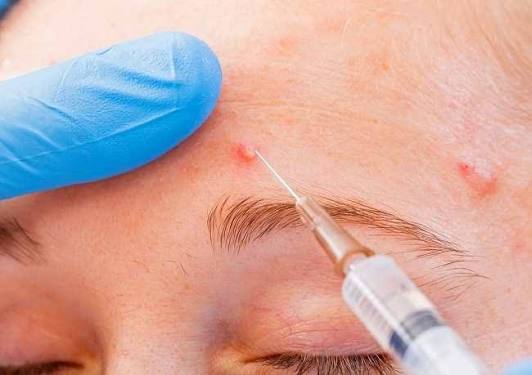 ACNE INJECTION KONDISI 2
