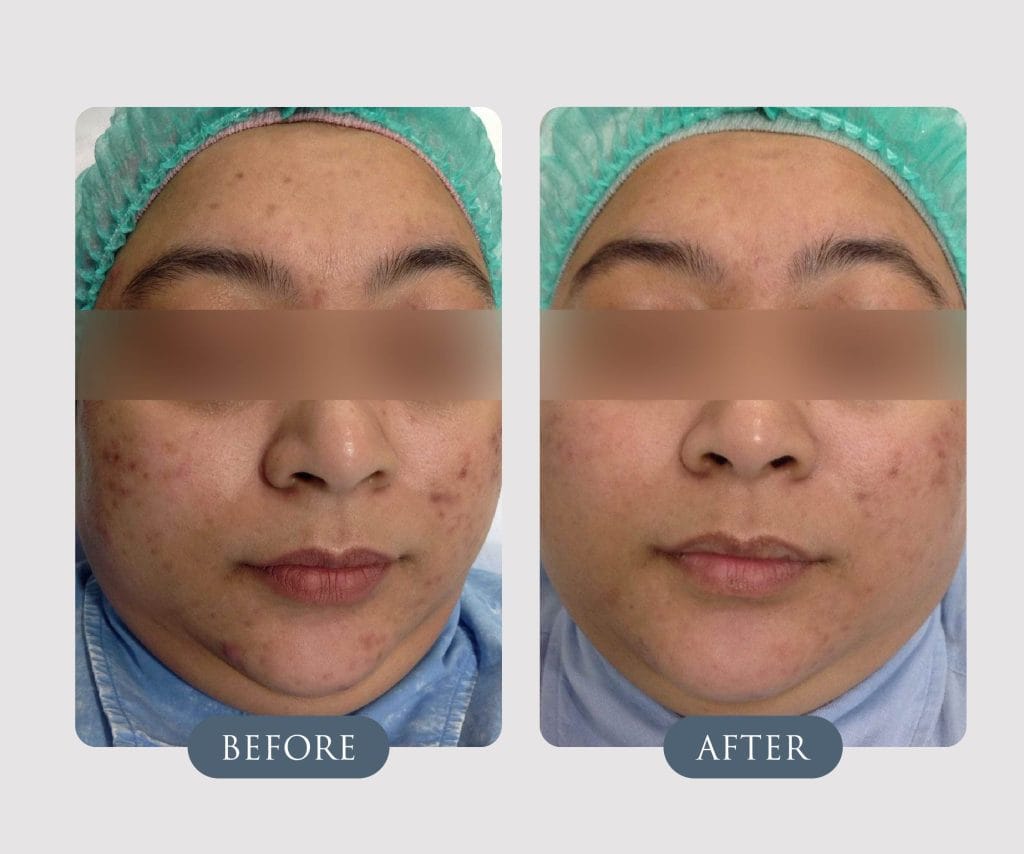 ACNE PEEL