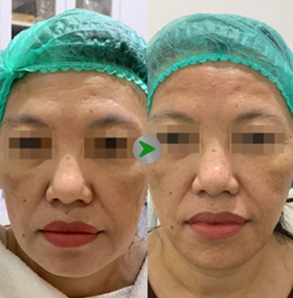 BOTOX RAHANG