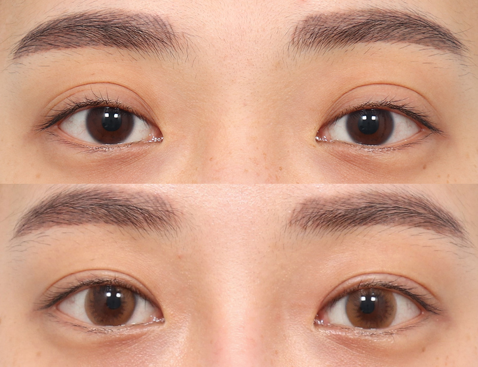 EYE LIFTING