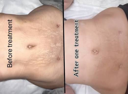 Fractional laser strech mark