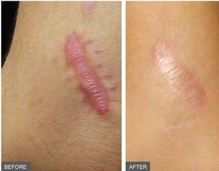 KELOID INJECTION KONDISI 3