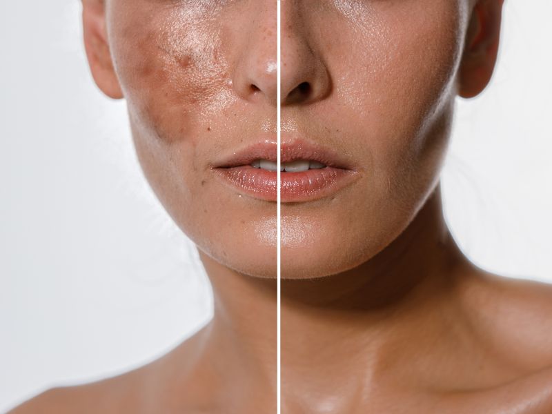 LIGHTENING PEEL