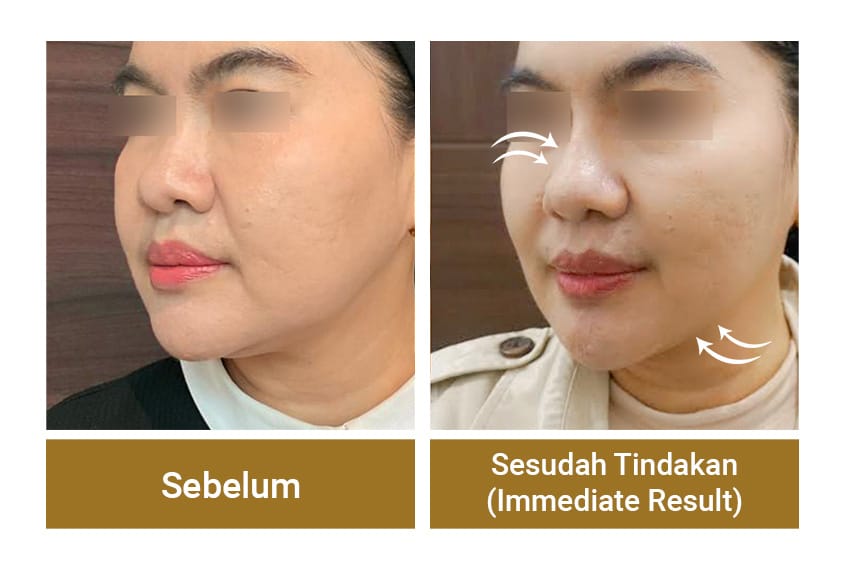 NOSE THREAD 3 PCS