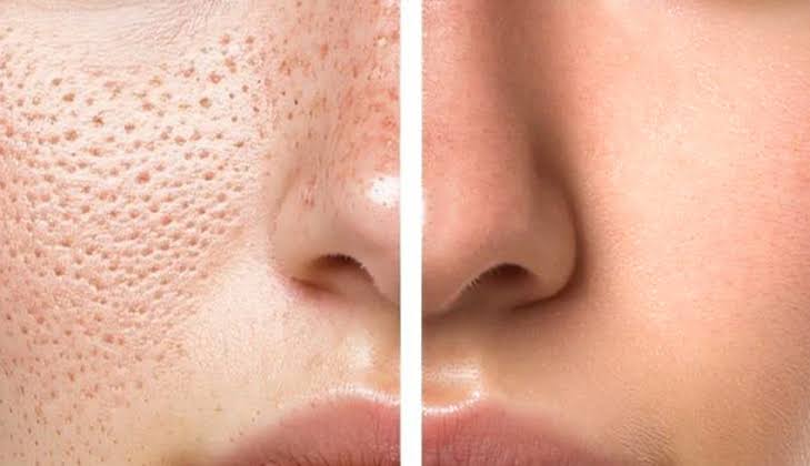 PORE TREATMENT