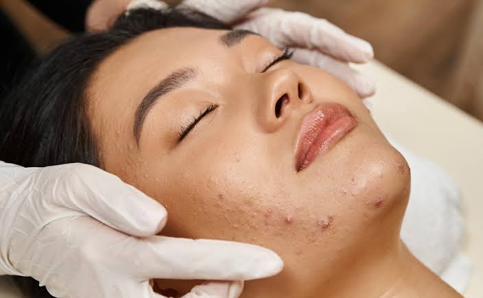 acne facial