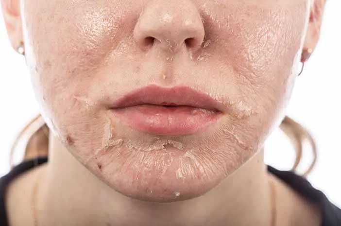 GLOWING PEEL